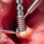 Implantologia stomatologiczna – co powinieneś wiedzieć o implantach zębowych?